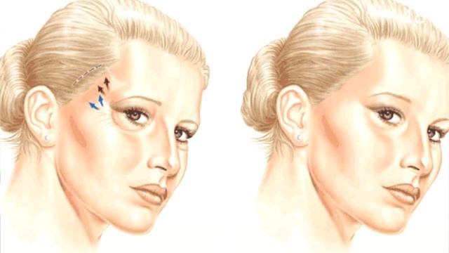 بهترین افراد برای عمل زیبایی لیفت شقیقه