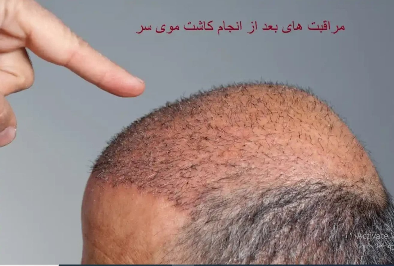 مراقبتهای بعد از کاشت مو در مشهد