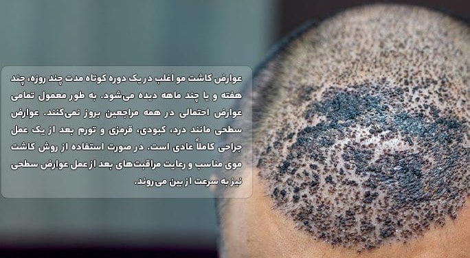عوارض ناشی از کاشت مو