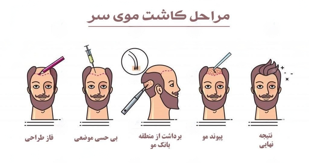 نحوه انجام کاشت موی طبیعی در مشهد