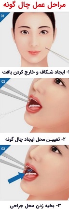 مراحل جراحی چال گونه در مشهد