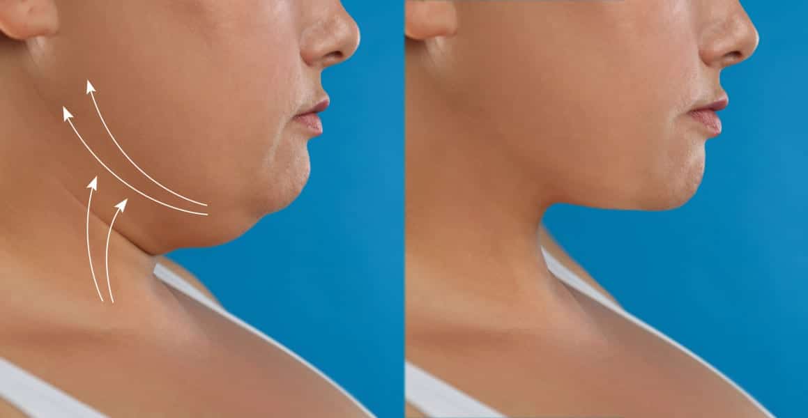 مزایا جراحی زیبایی غبغب در مشهد