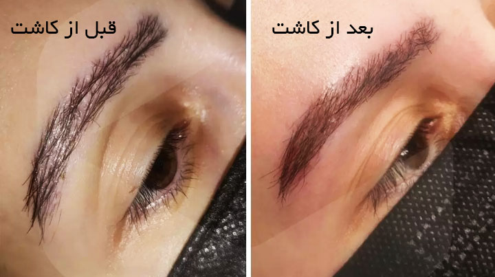 مزایا کاشت ابرو مشهد 