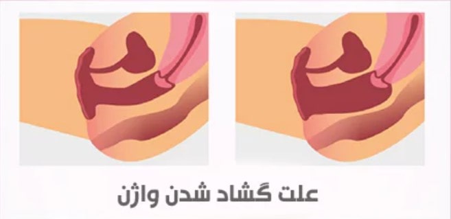 علل گشاد شدن واژن