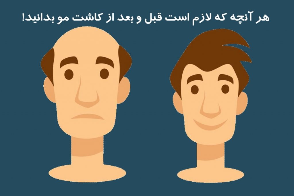 هزینههای قبل و بعد از کاشت مو در مشهد