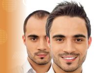 هزینه کاشت مو در مشهد