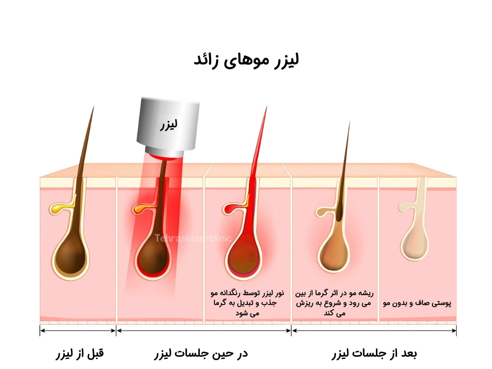 مراحل لیزر مو مشهد 
