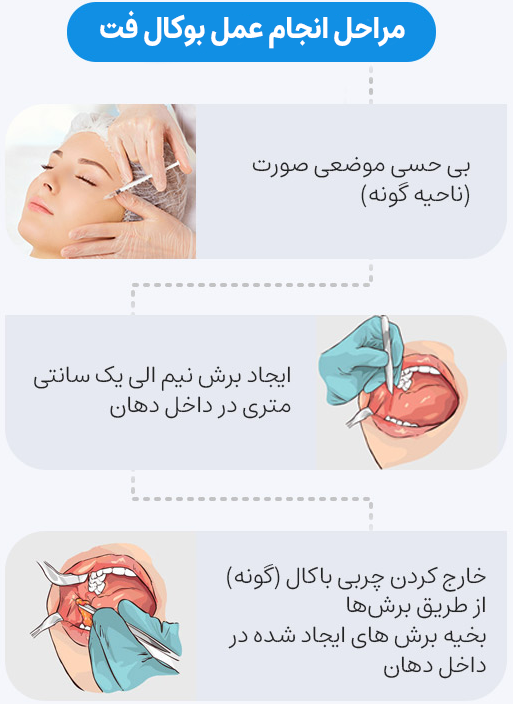 پروسه انجام عمل بوکال فت در مشهد