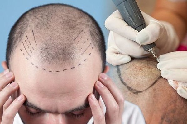 هزینههای جانبی عمل کاشت مو در مشهد