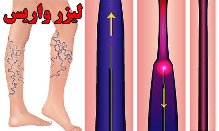 انواع لیزر واریس در مشهد 
