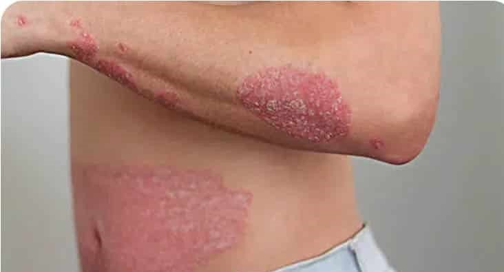 هزینه درمان توسط متخصص قارچ پوستی مشهد