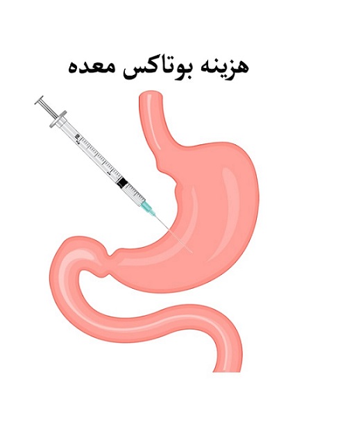 هزینه بوتاکس معده مشهد