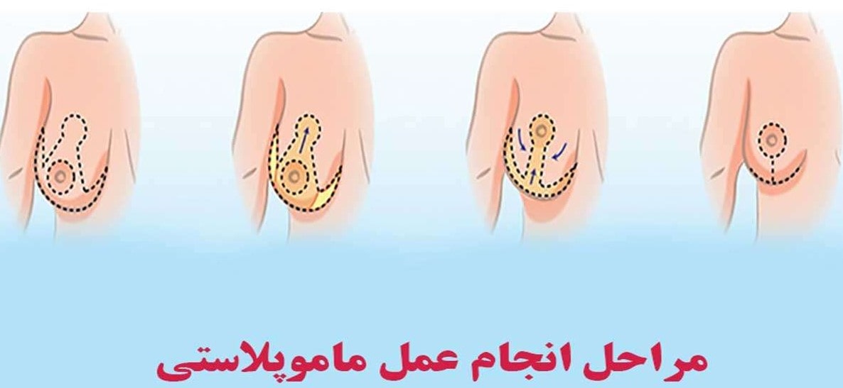 مراحل عمل مامو پلاستی در مشهد