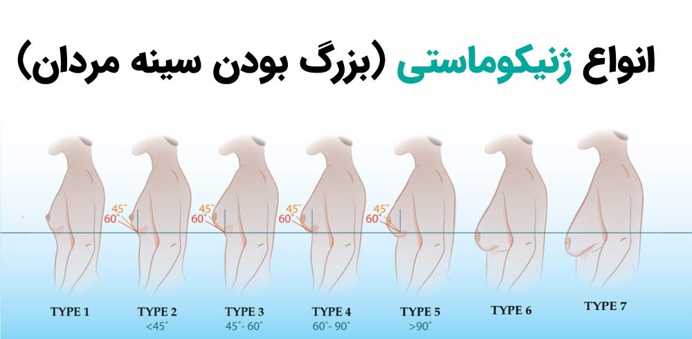 انواع ژنیکوماستی در مشهد