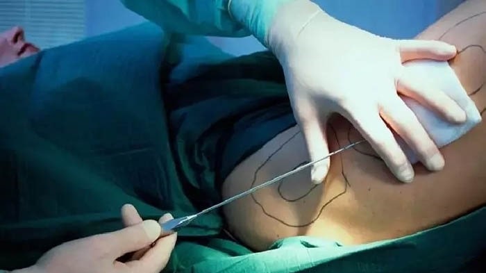 انواع روشهای پیکرتراشی بدون جراحی در مشهد