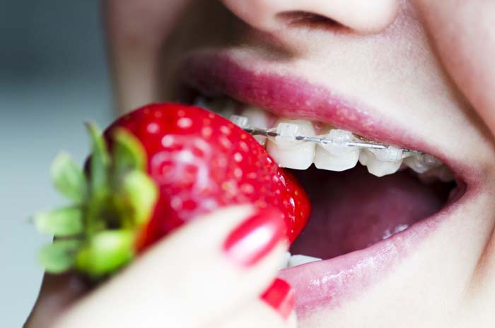 رژیم غذایی مناسب بعد از ارتودنسی در مشهد