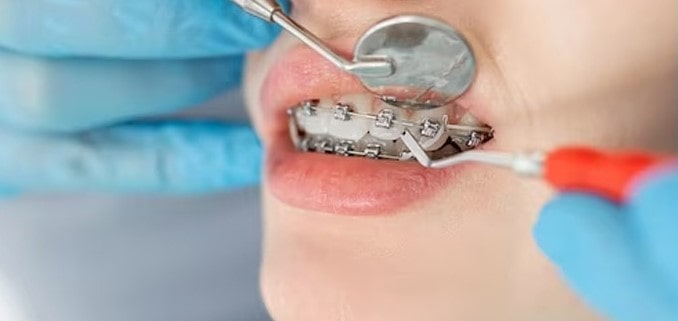 مراحل انجام خدمات ارتودنسی توسط دکتر ارتودنسی مشهد