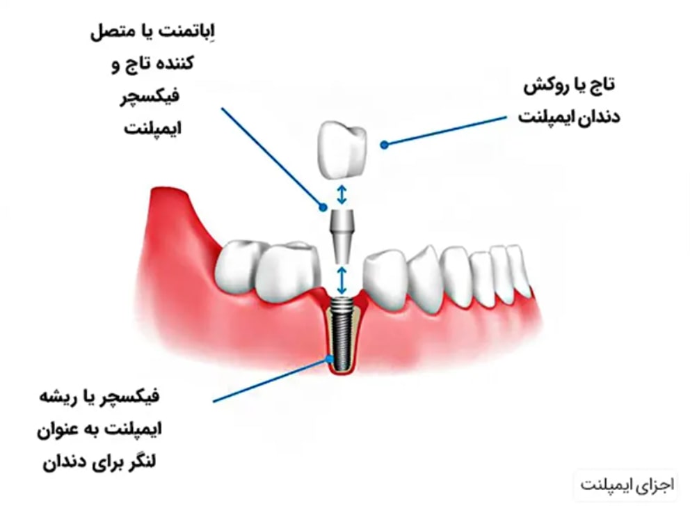 اجزای اصلی ایمپلنت دندان 