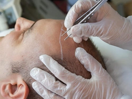 دوره نقاهت و مراقبت های بعد از کاشت مو به روش bht در مشهد